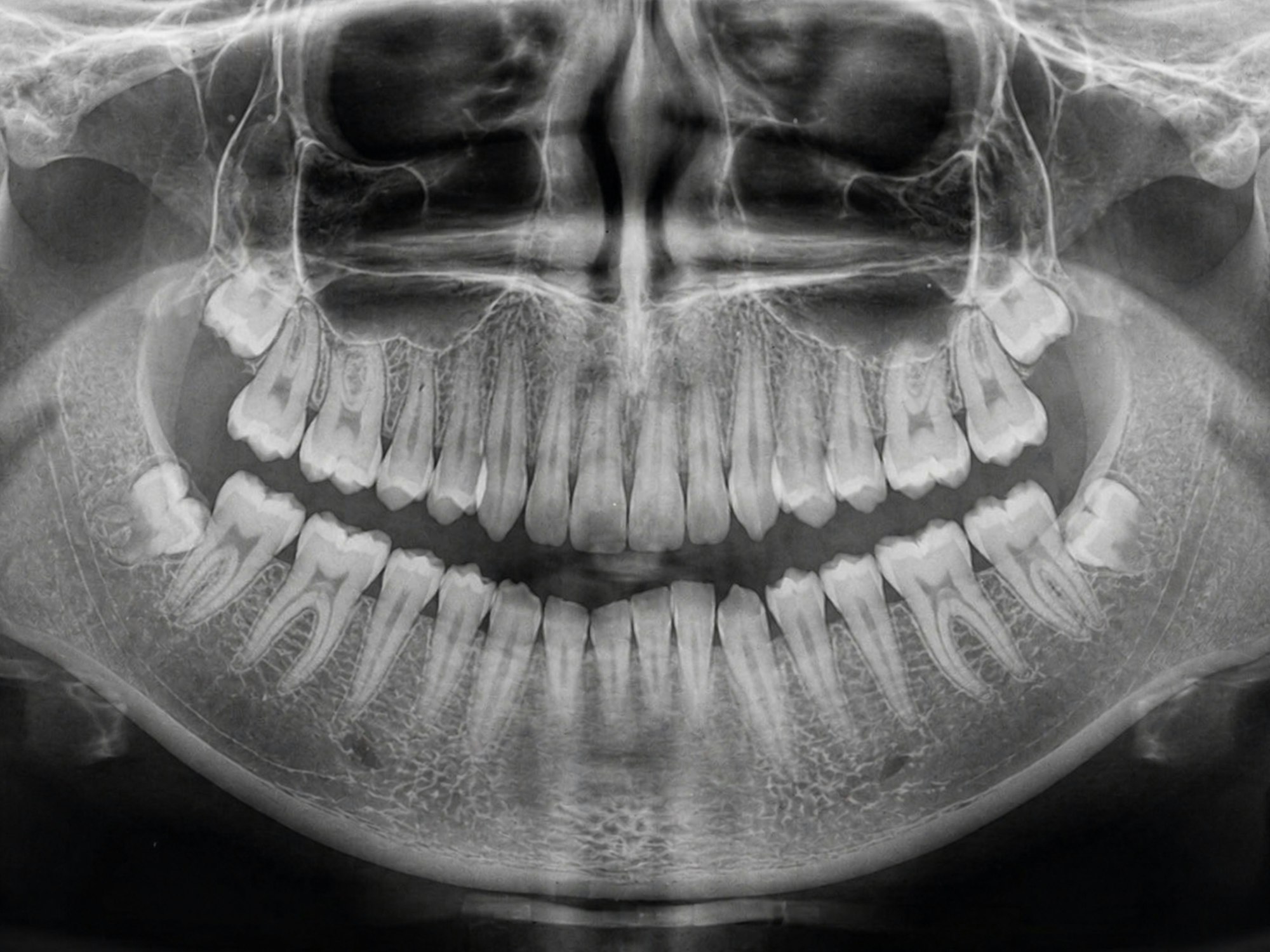 A panoramic dental x-ray showing teeth and jawbone